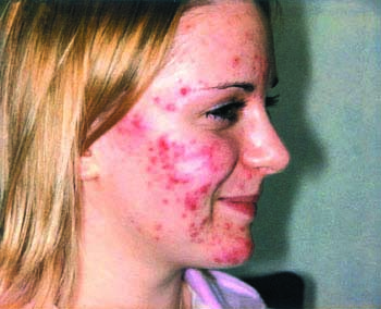 Causes of Acne vulgaris