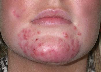 Symptoms of Acne vulgaris