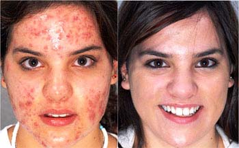 Homeopathic treatment for Acne Vulgaris