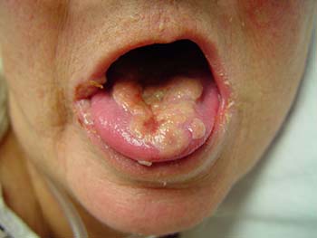 Oral to oral herpes