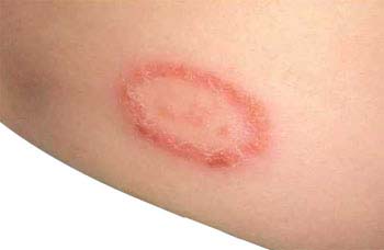 herpes eczema #11