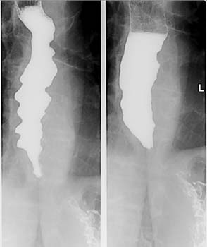 achalasia cardia diagnosis and tests