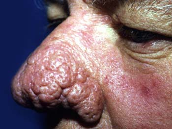 Complications of Acne Rosacea