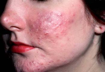 Definition of Acne Rosacea