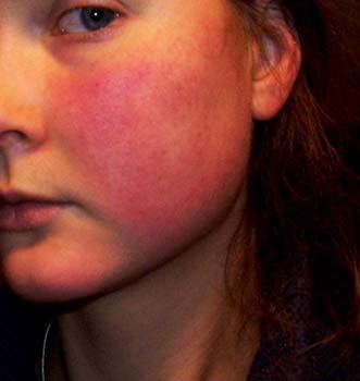 Symptoms of Acne Rosacea