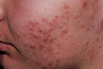 Definition of Acne vulgaris