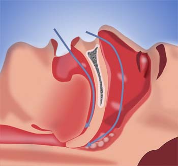 Adenoids_Definition