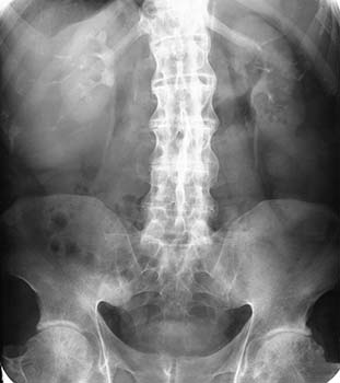 Tests & Diagnosis Of Ankylosing Spondylitis