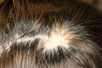 Introduction of Alopecia Areata (Hair Loss)