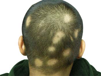 Symptoms of Alopecia Areata (Hair Loss)