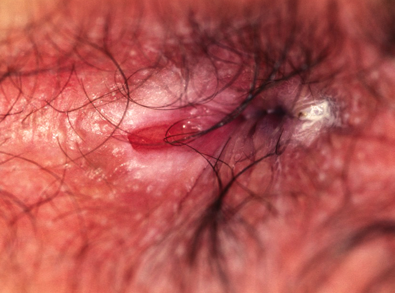 Overview of anal-fissure