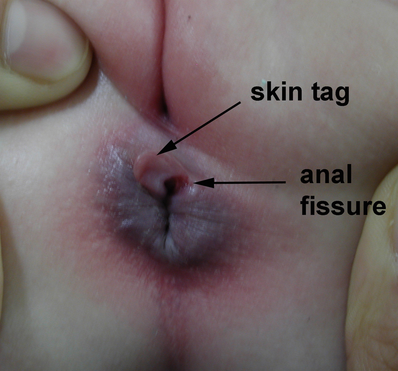 symptoms-or-causes-of-anal-bleeding