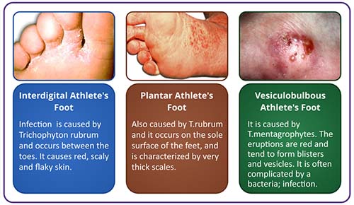 symptoms of athletes foot