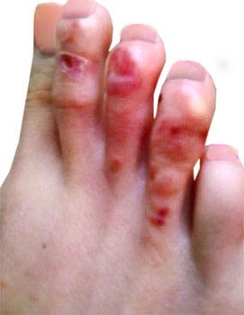 Types of ringworm: tinea pedis and tinea ... - MedicineNet