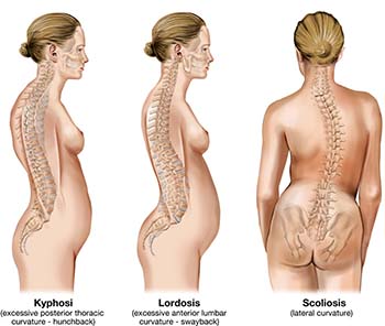 causes of back pain