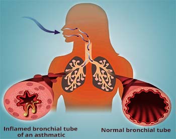 Bronchial Asthma Definition - WelcomeCure