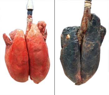 COPD_definition_3
