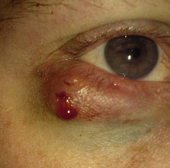 chalazion complications