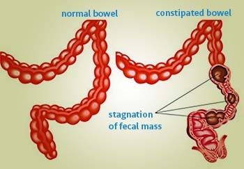 chronic constipation introduction