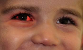 conjunctivitis_Introduction