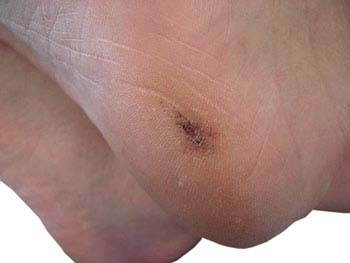 Similar conditions of Corns and Calluses
