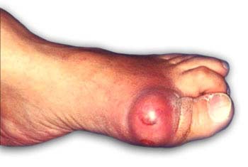 Similar conditions of Corns and Calluses
