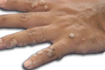 Similar conditions of Corns and Calluses