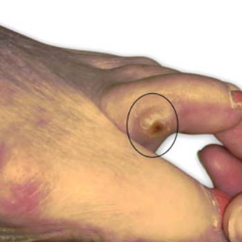 Allopathic medicine for foot corn shop