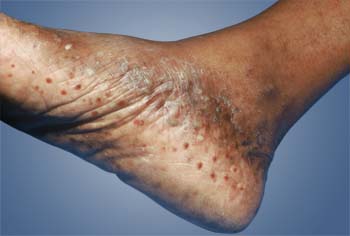 Eczema causes clearance