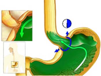 Risk factors of GERD