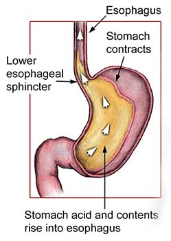 Causes of GERD