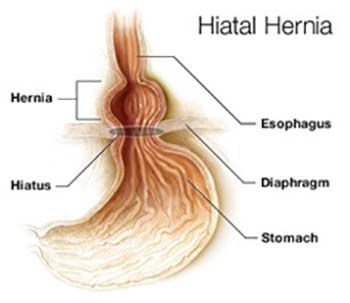 Causes of GERD