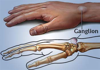 ganglion cyst categorization