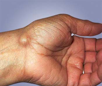 ganglion cyst introduction