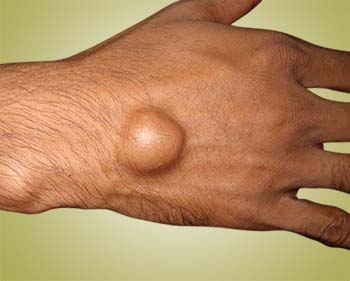 ganglion cyst