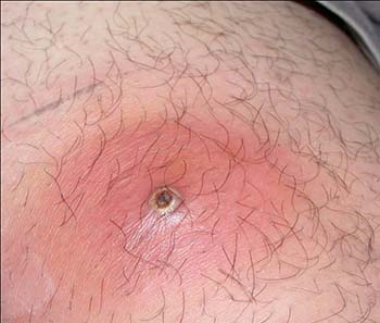 What Does Herpes Look Like - Pictures of STDs - The STD ...