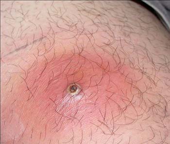 Genital Herpes Pictures - Herpes Pictures