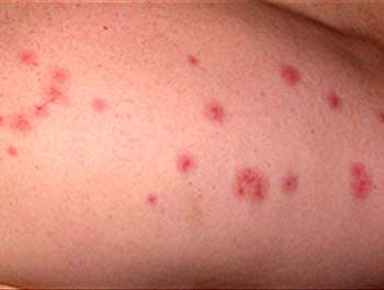 Similar Conditions of Genital Herpes