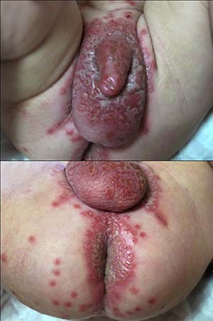 Introduction of Genital Herpes