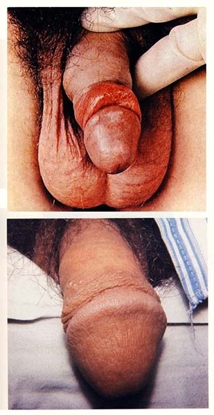 Symptoms of Genital Herpes