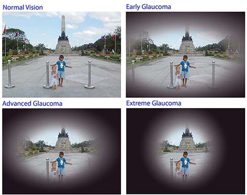 glaucoma symptoms