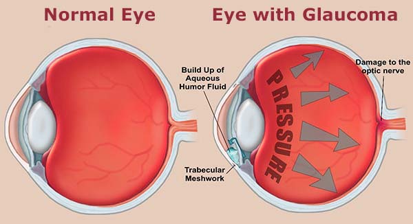 Resultado de imagen de glaucoma