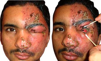 Complications of Herpes Zoster