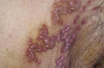Shingles (Herpes Zoster) Overview
