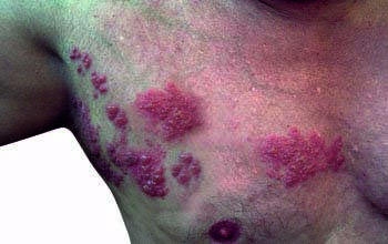 Shingles (Herpes Zoster) Overview