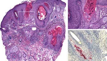 Shingles (Herpes Zoster) Tests and Diagnosis