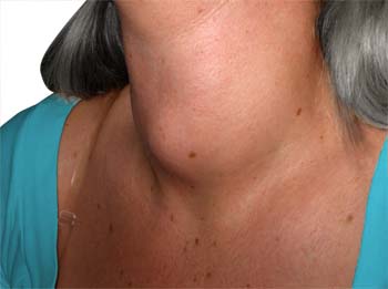 Symptoms of Hypothyroidism