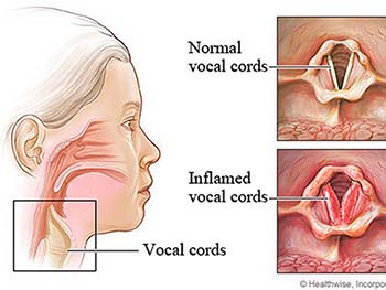 laryngitis diagram