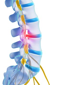 lumbar spondylosis introduction