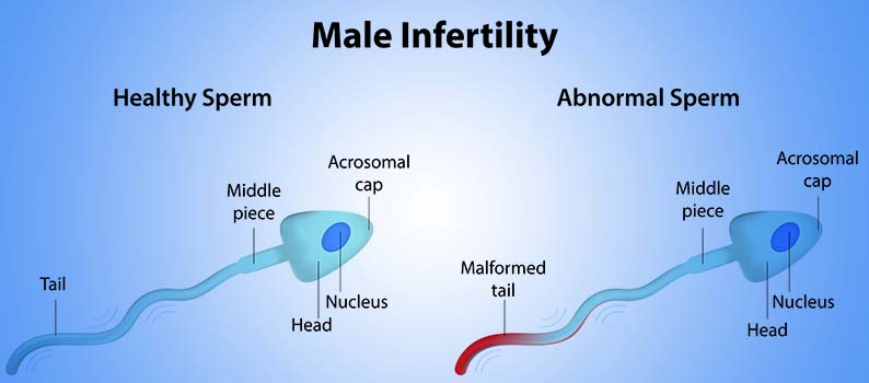 Azoospermia Treatment